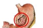“胃癌是全球范围内发病率最高的癌症之一